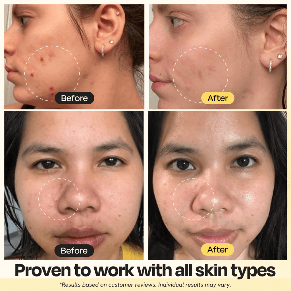 Deep Cleansing Nose Strips for Acne & Blackhead Removal Shrink Pore Nose Black Head Stickers Refreshing Skin Care Patch